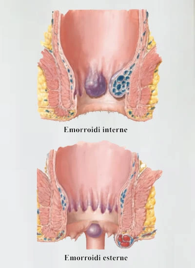 Emorroidi sintomi