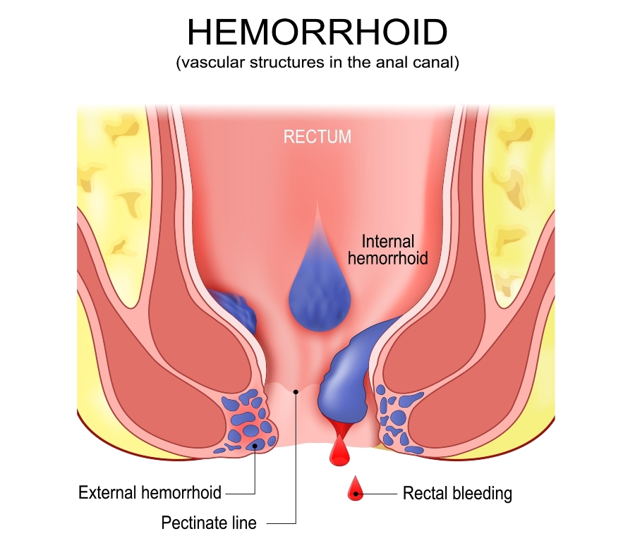 Emorroidi: Sintomi, Cause, Rimedi e Cura