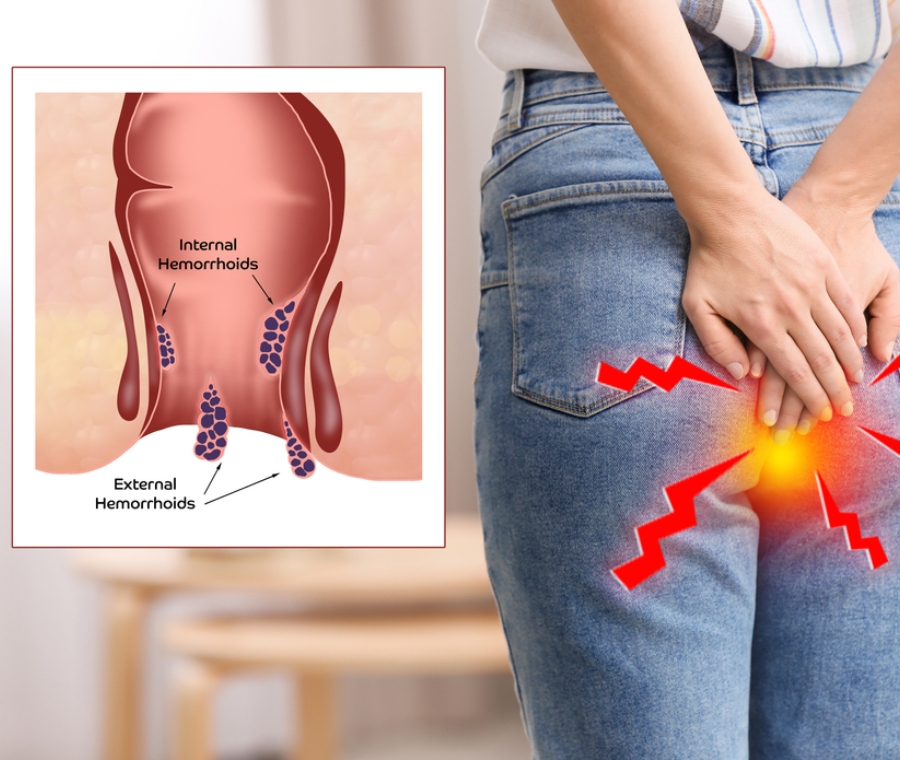 Sintomi Emorroidi e Diagnosi: Come Riconoscerle