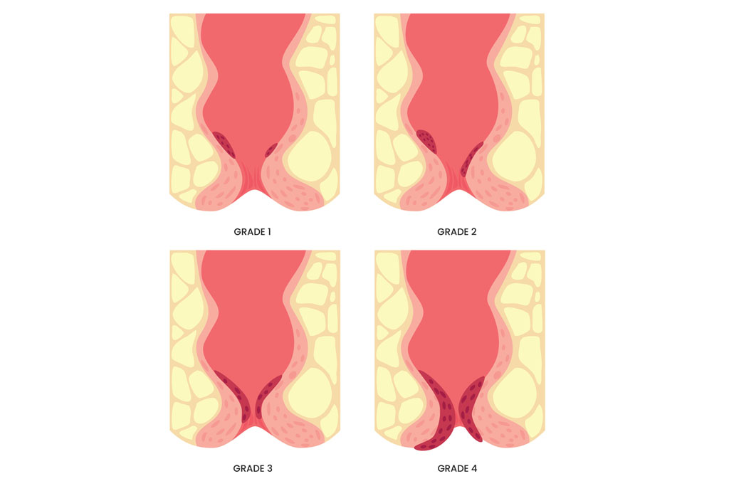 gradi delle emorroidi, classificazione e sintomi